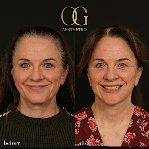 Facelift Before & After Gallery - Patient 330678 - Image 2