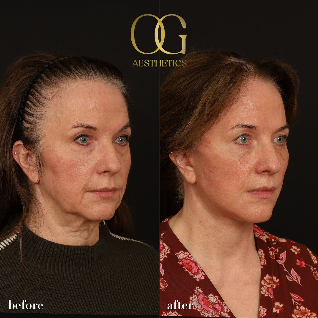 Facelift Before & After Gallery - Patient 330678 - Image 3
