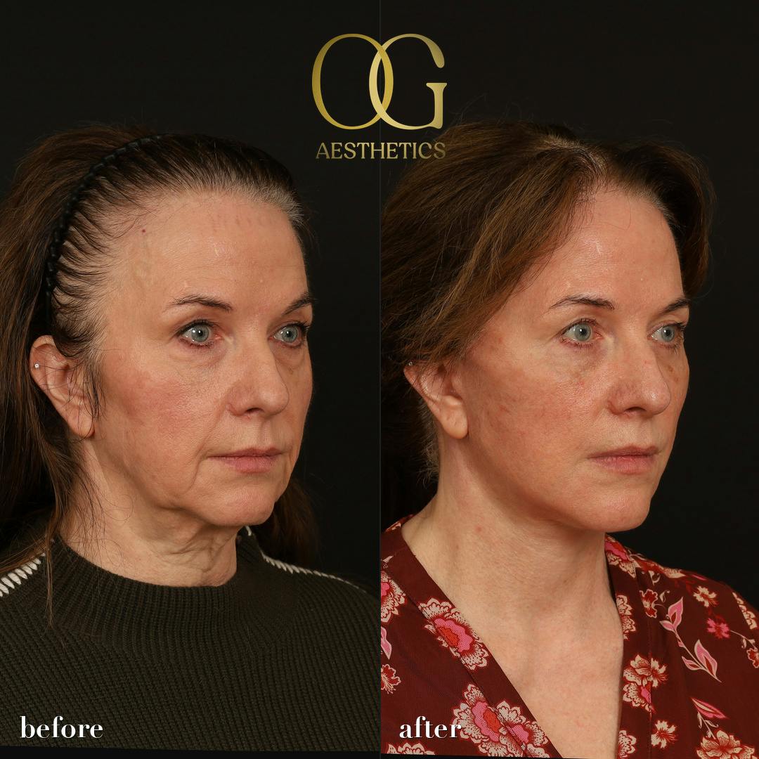 Facelift Before & After Gallery - Patient 330678 - Image 3