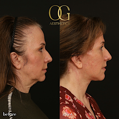 Facelift Before & After Gallery - Patient 330678 - Image 4