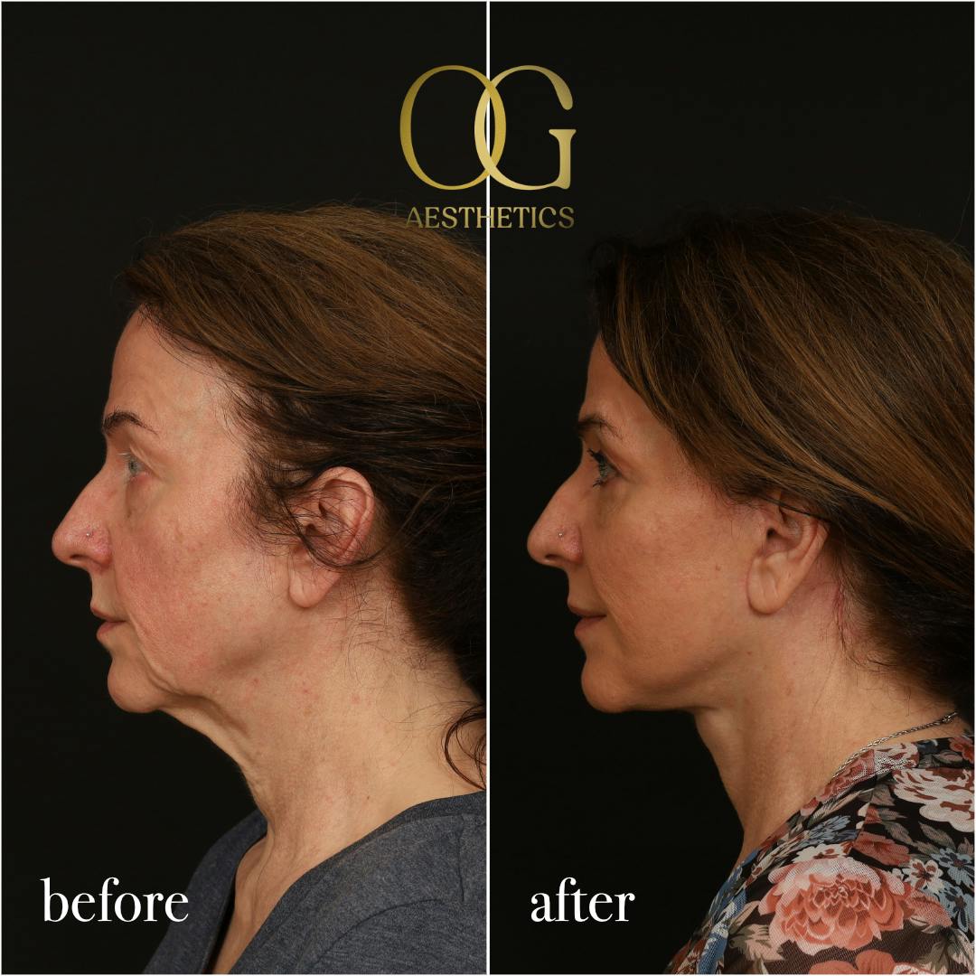 Facelift Before & After Gallery - Patient 330678 - Image 6
