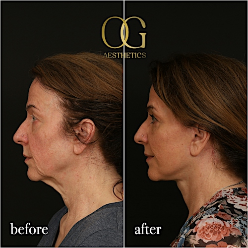 Facelift Before & After Gallery - Patient 330678 - Image 6