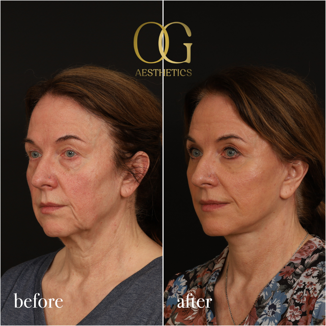 Facelift Before & After Gallery - Patient 330678 - Image 5