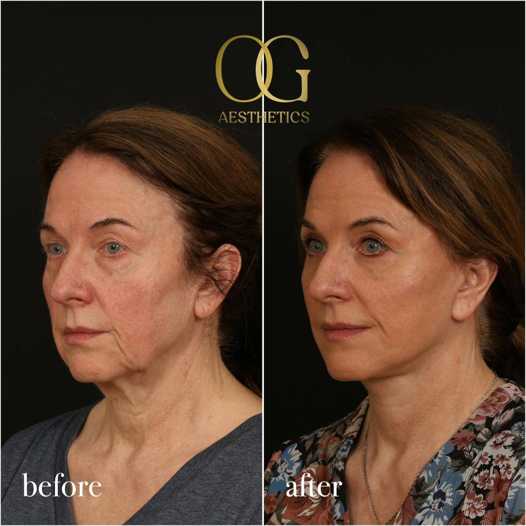 Facelift Before & After Gallery - Patient 330678 - Image 5