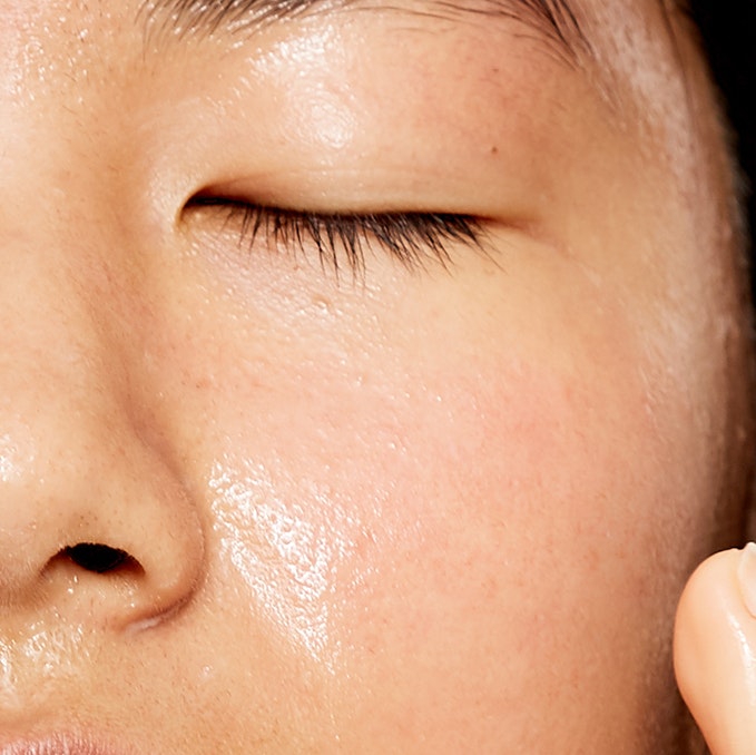 Chemical Peel