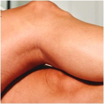 Laser Hair Removal