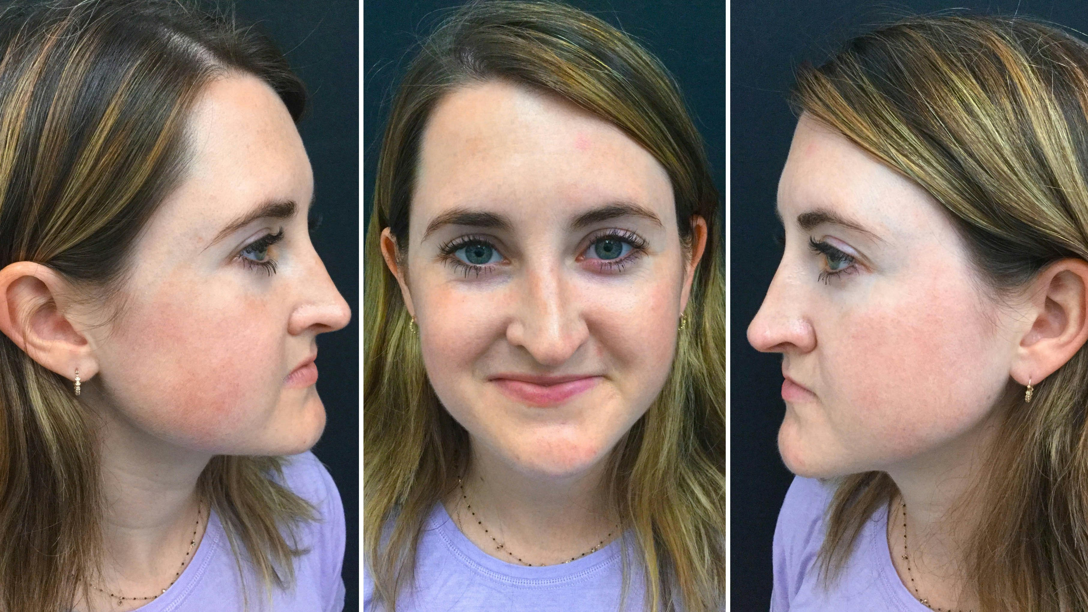 After 3rd Treatment