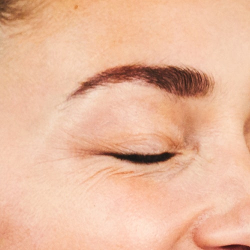 Injectable Wrinkle Reducers