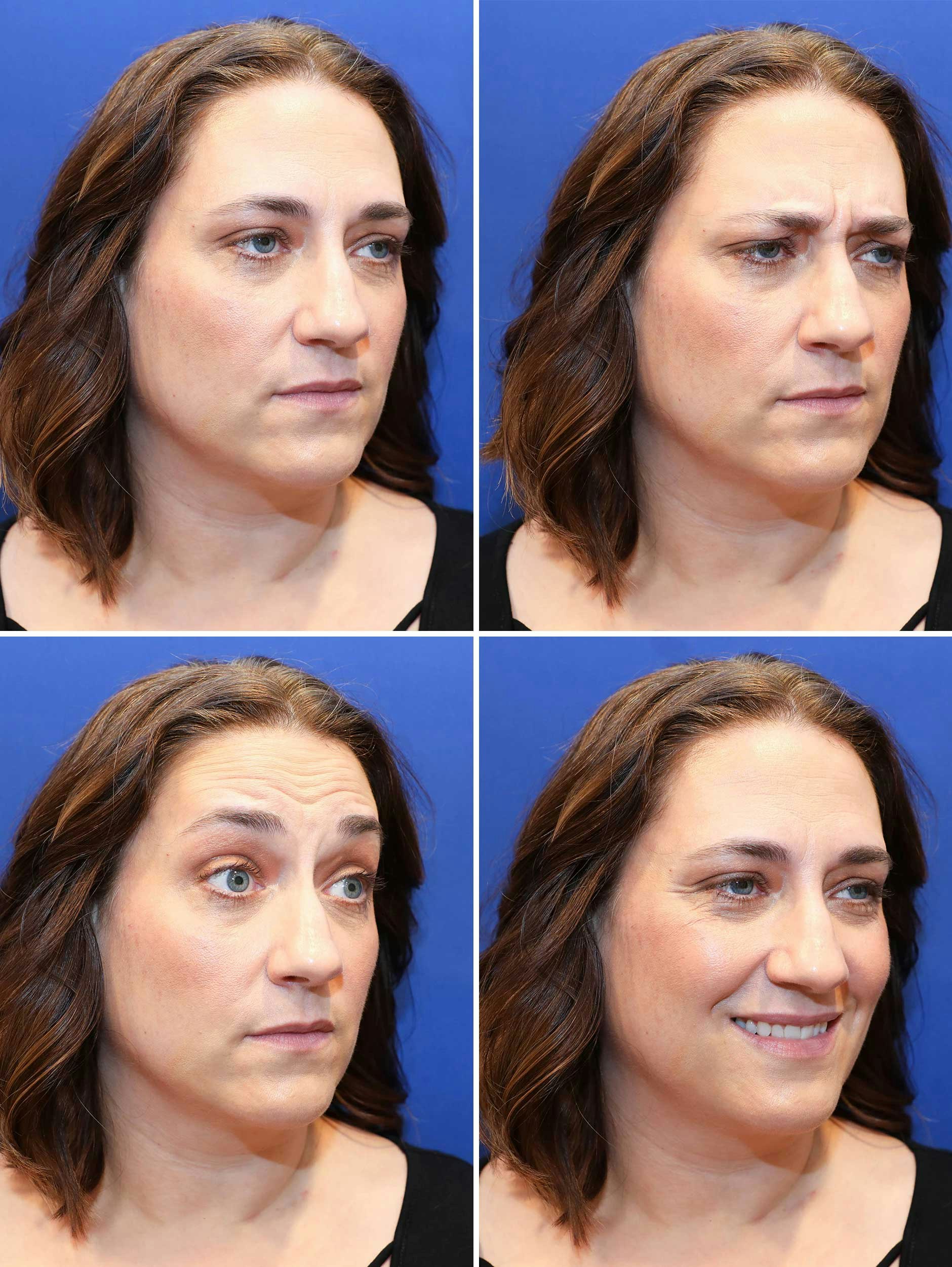 Injectable Wrinkle Reducers - Before Treatment