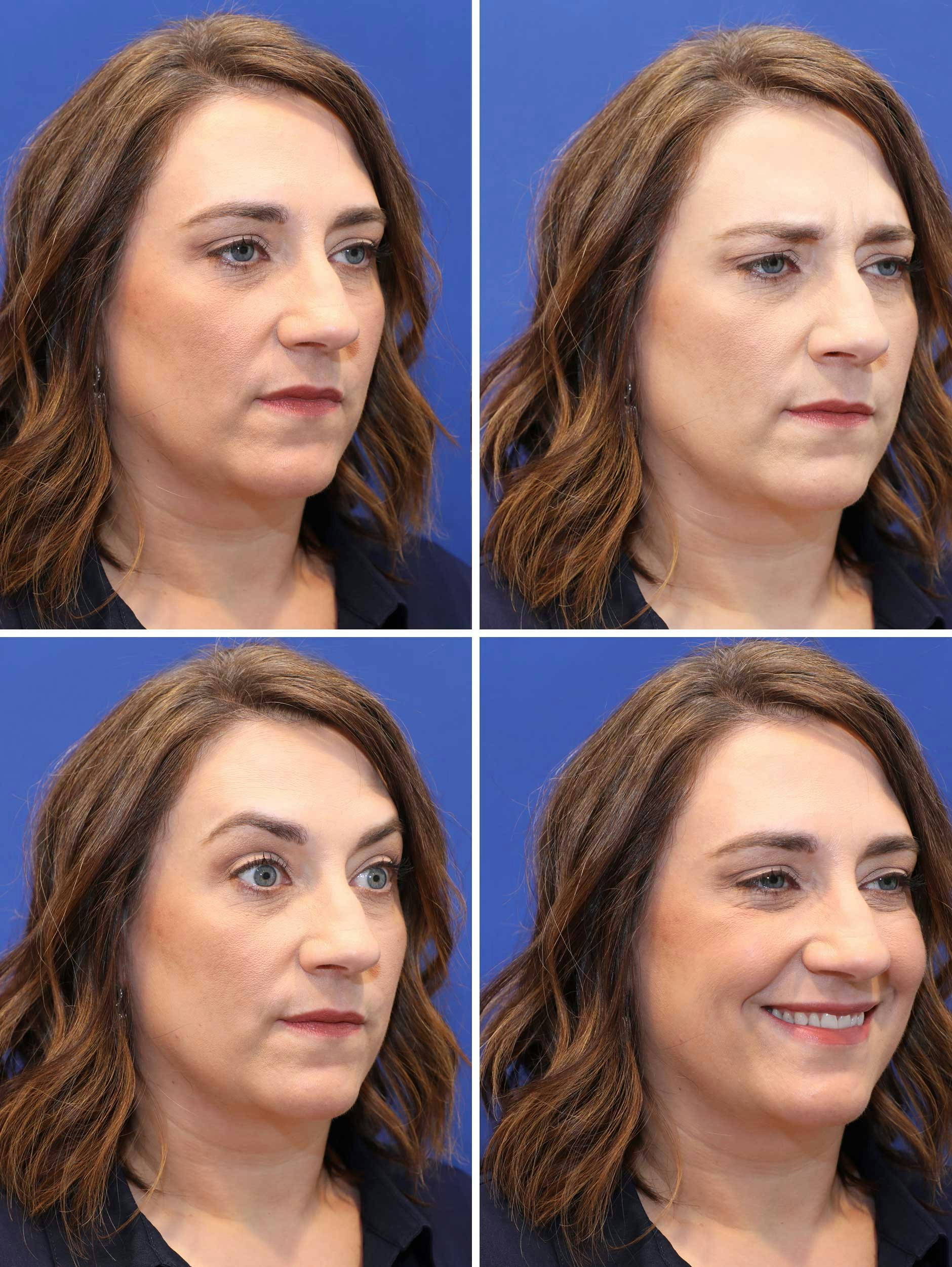 Injectable Wrinkle Reducers - After Treatment