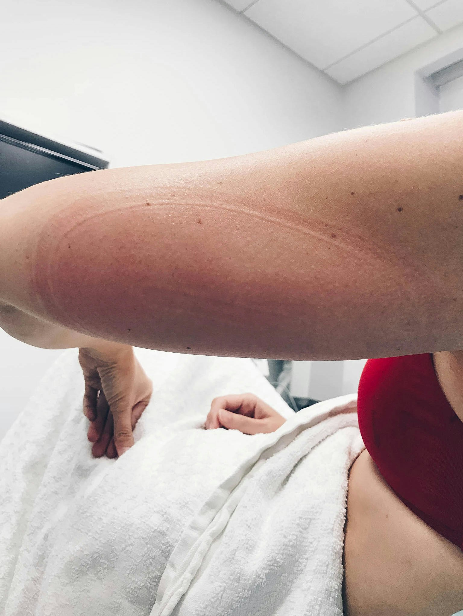 Upper arm after CoolSculpting treatment.