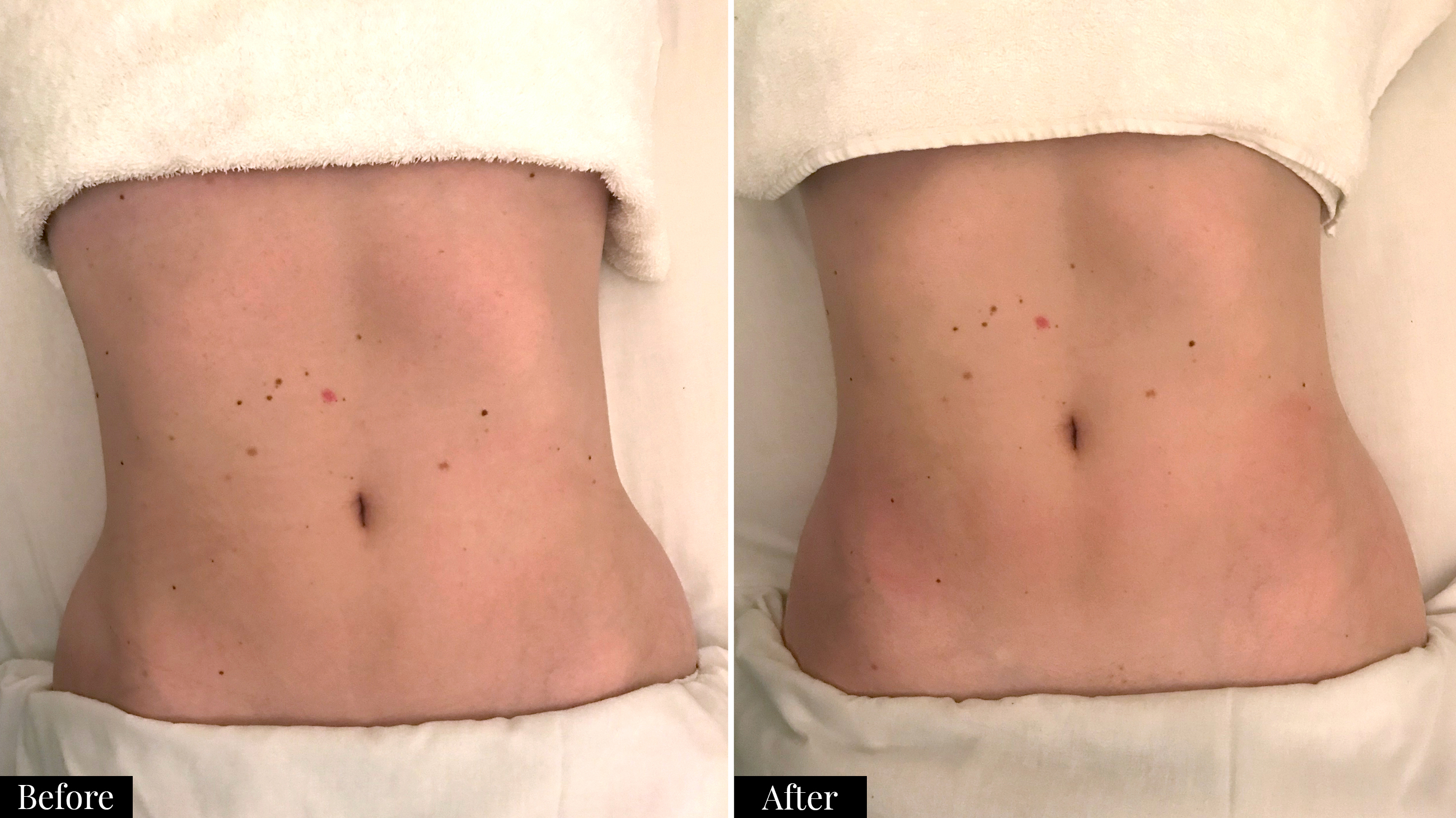 Lymphatic Drainage Before And After Best Drain Photos