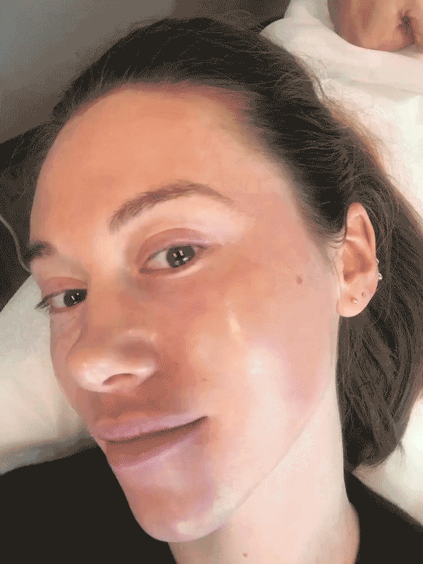 co2 fractional laser