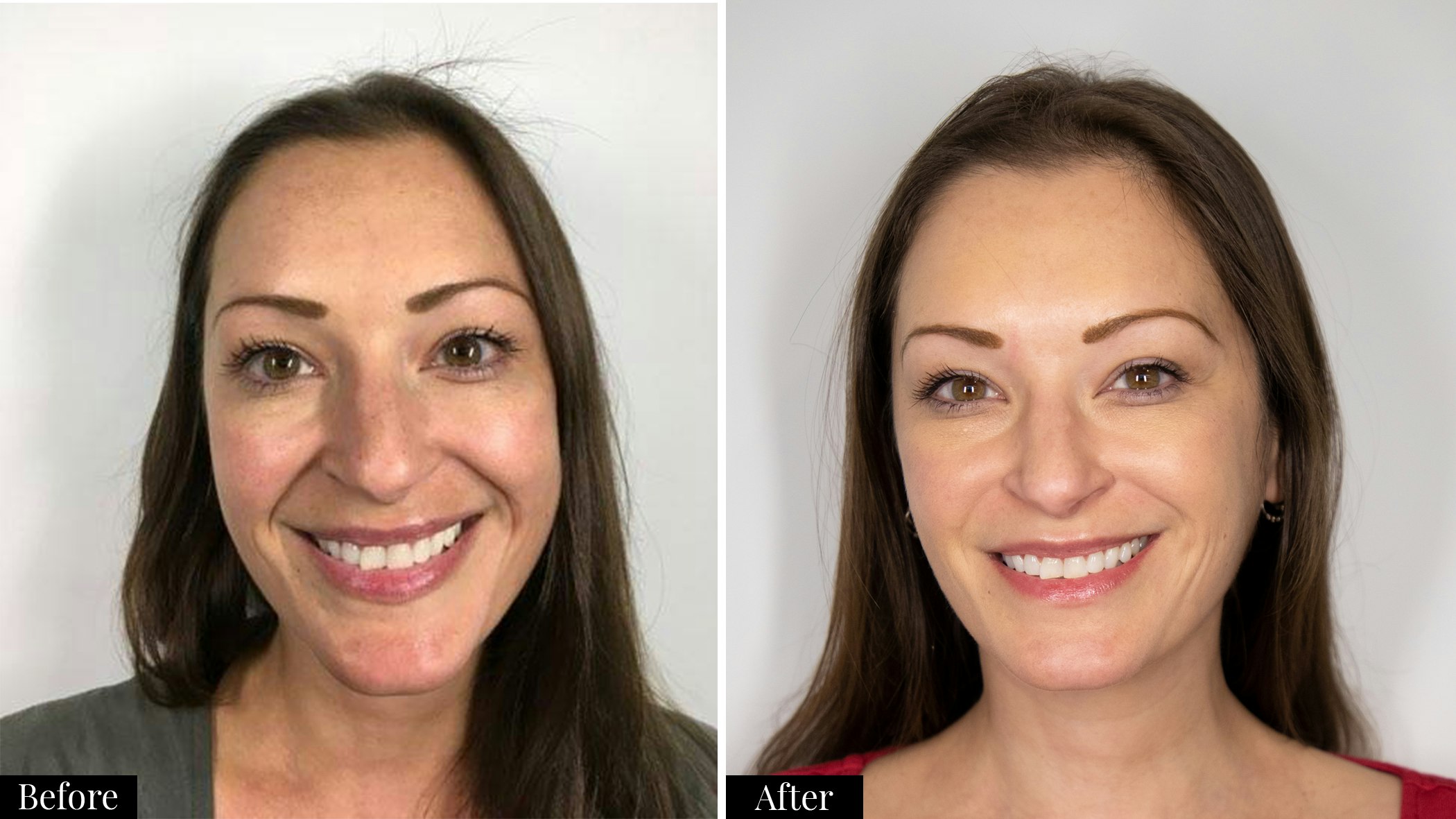 Nasolabial fold filler before and after 