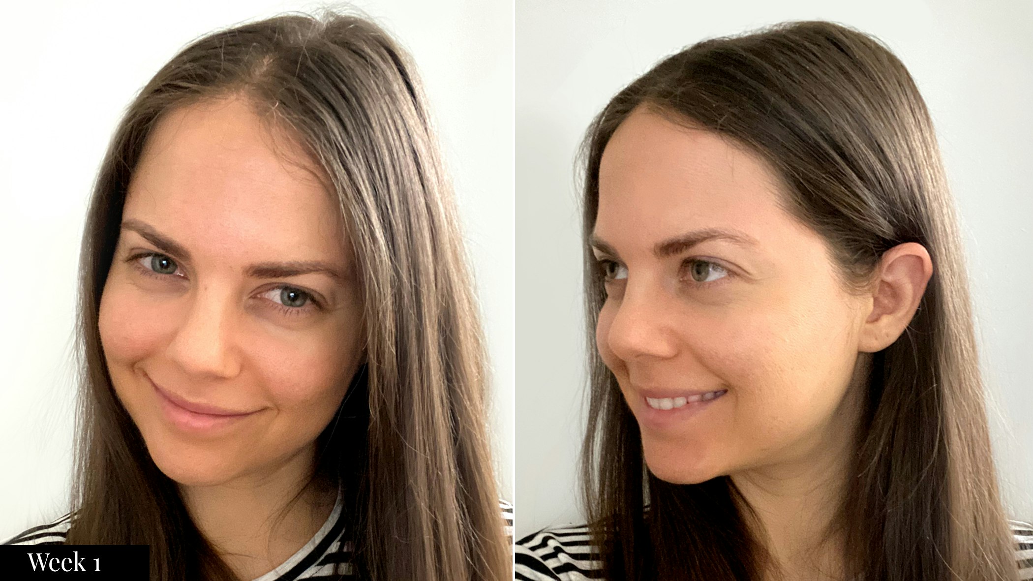 SkinMedica skincare results after one week