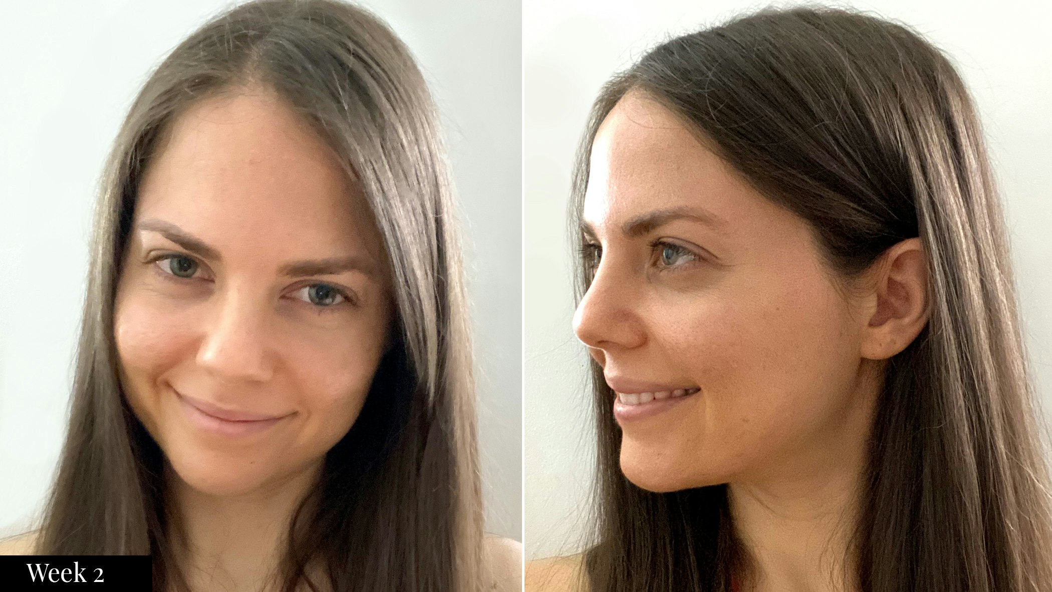SkinMedica skincare results after two weeks