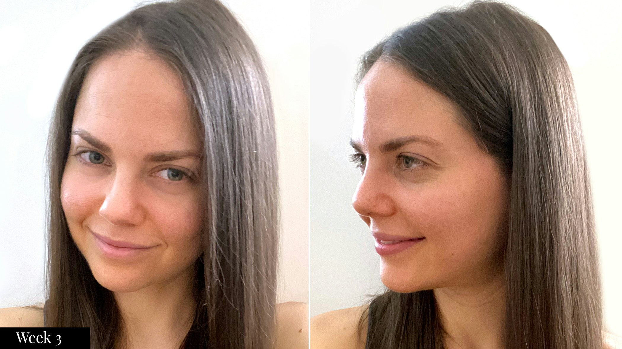 SkinMedica skincare results after three weeks | Spotlyte