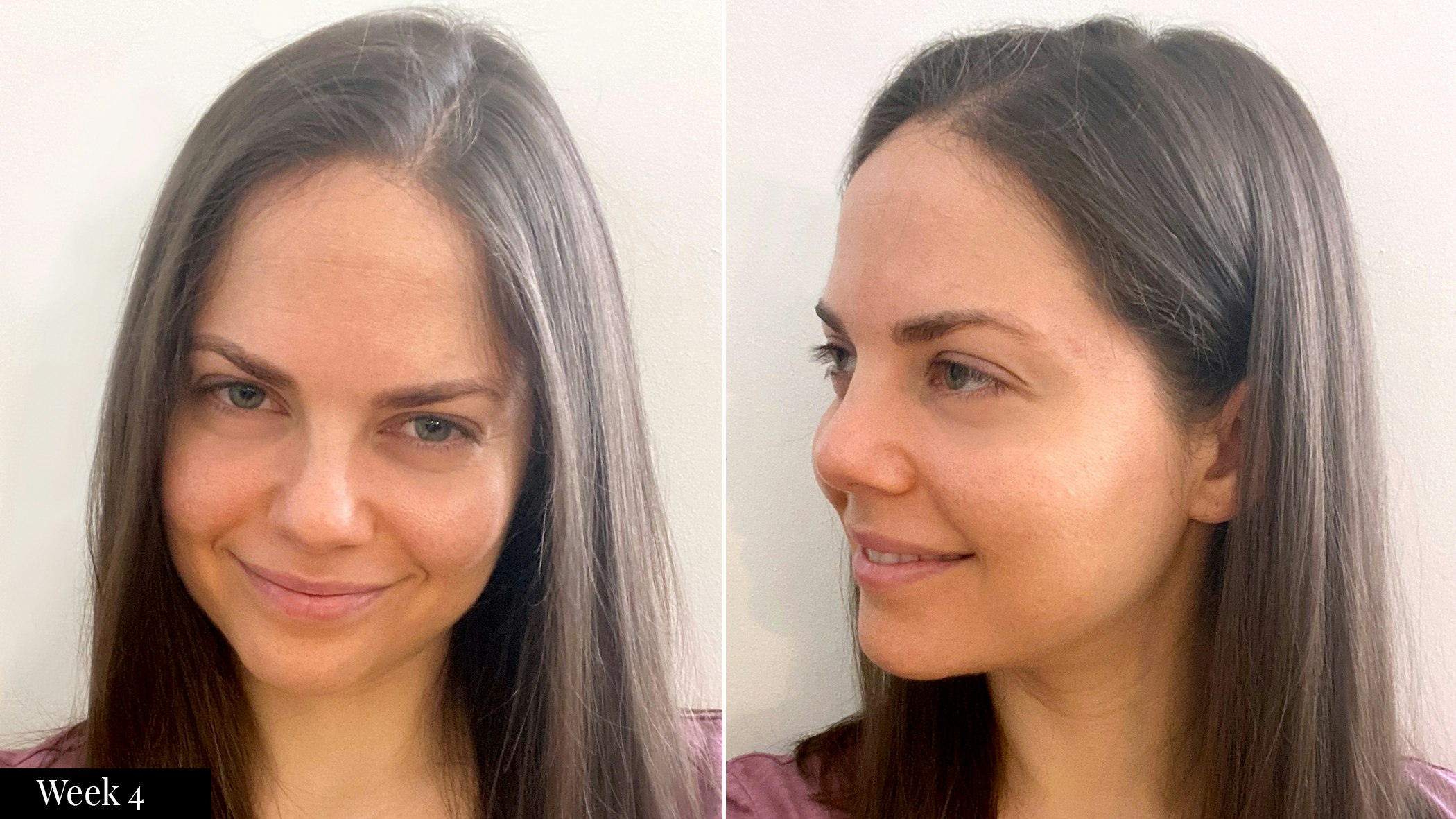 SkinMedica skincare results after four weeks | Spotlyte