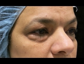 Blepharoplasty Before & After Gallery - Patient 58232293 - Image 1