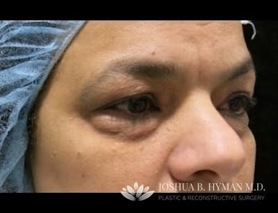 Blepharoplasty Before & After Gallery - Patient 58232293 - Image 1