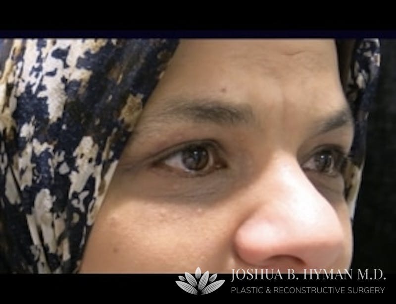 Blepharoplasty Before & After Gallery - Patient 58232293 - Image 2