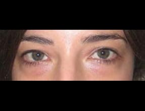 Blepharoplasty Before & After Gallery - Patient 58232295 - Image 1