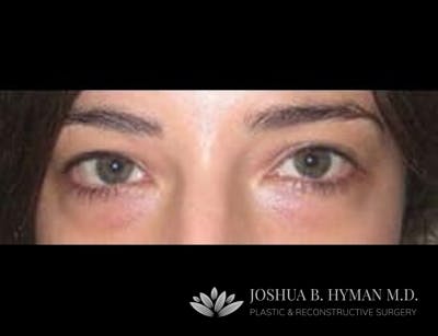 Blepharoplasty Before & After Gallery - Patient 58232295 - Image 1