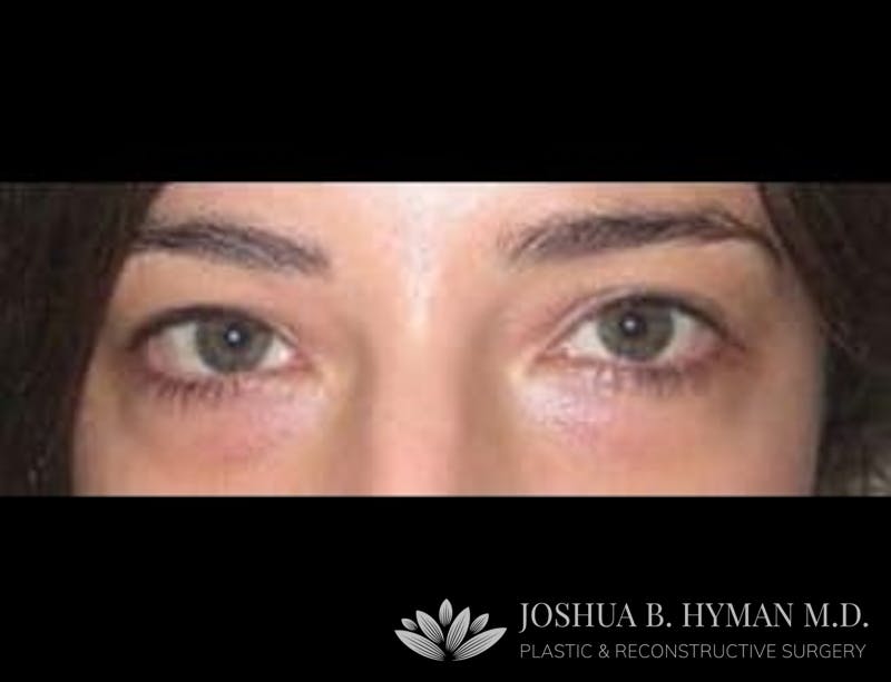 Blepharoplasty Before & After Gallery - Patient 58232295 - Image 1