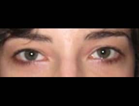 Blepharoplasty Before & After Gallery - Patient 58232295 - Image 2