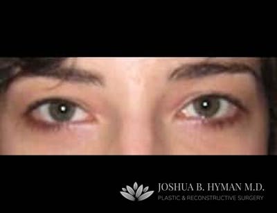 Blepharoplasty Before & After Gallery - Patient 58232295 - Image 2