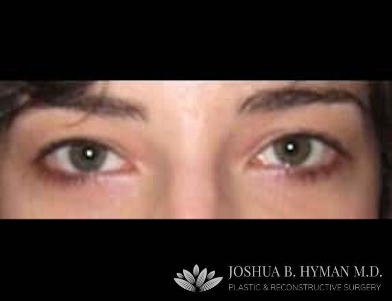 Blepharoplasty Before & After Gallery - Patient 58232295 - Image 2