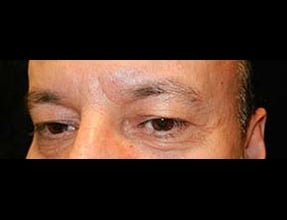 Blepharoplasty Before & After Gallery - Patient 58232297 - Image 1