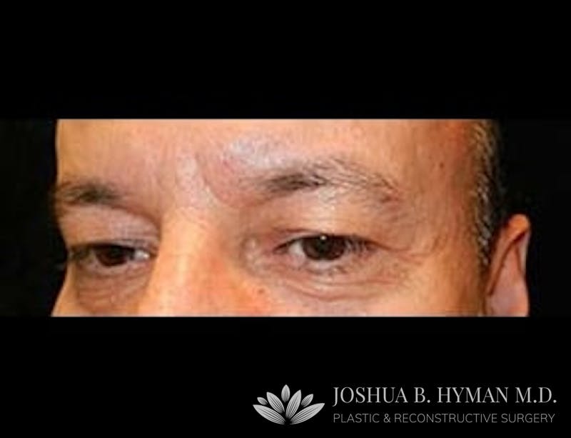 Blepharoplasty Before & After Gallery - Patient 58232297 - Image 1