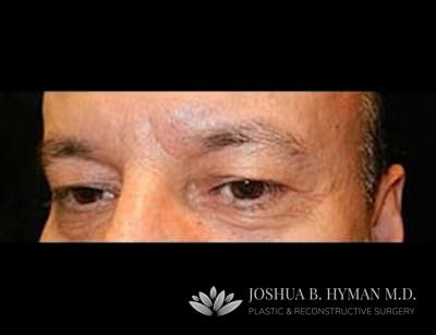 Blepharoplasty Before & After Gallery - Patient 58232297 - Image 1