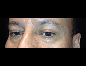 Blepharoplasty Before & After Gallery - Patient 58232297 - Image 2