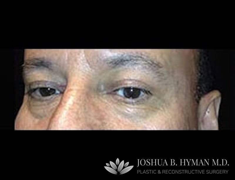 Blepharoplasty Before & After Gallery - Patient 58232297 - Image 2