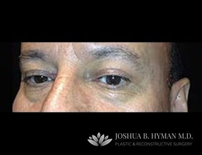 Blepharoplasty Before & After Gallery - Patient 58232297 - Image 2