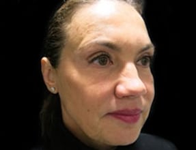 Facelift Before & After Gallery - Patient 58232299 - Image 1