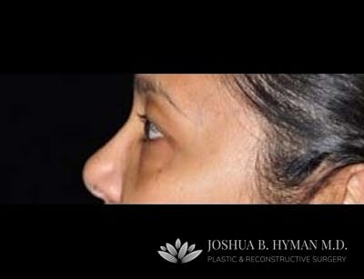 Blepharoplasty Before & After Gallery - Patient 58232300 - Image 1