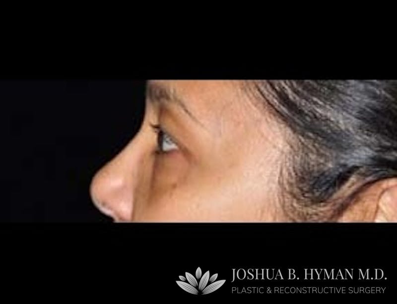 Blepharoplasty Before & After Gallery - Patient 58232300 - Image 1