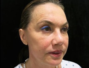 Facelift Before & After Gallery - Patient 58232299 - Image 2