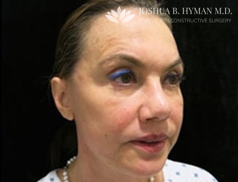 Facelift Before & After Gallery - Patient 58232299 - Image 2