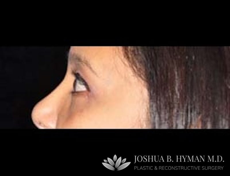 Blepharoplasty Before & After Gallery - Patient 58232300 - Image 2