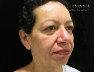 Facelift Before & After Gallery - Patient 58232303 - Image 1