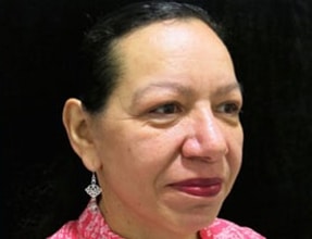 Facelift Before & After Gallery - Patient 58232303 - Image 2