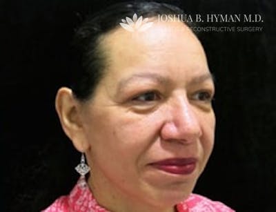 Facelift Before & After Gallery - Patient 58232303 - Image 2