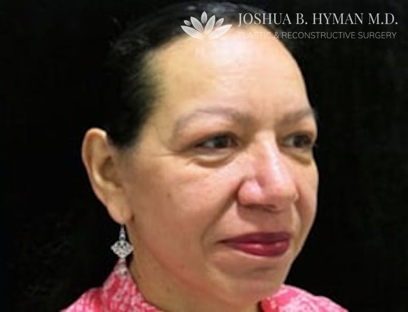 Facelift Before & After Gallery - Patient 58232303 - Image 2