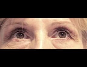 Blepharoplasty Before & After Gallery - Patient 58232304 - Image 1