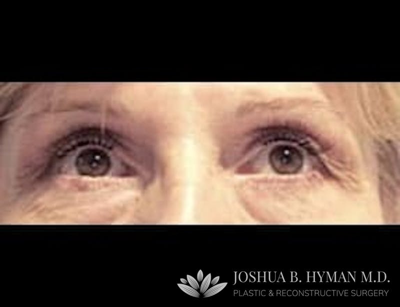Blepharoplasty Before & After Gallery - Patient 58232304 - Image 1