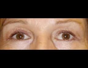 Blepharoplasty Before & After Gallery - Patient 58232304 - Image 2